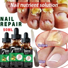 New Nail Fungus Treatment Essence Serum Care Hand and Foot Care Removal Repair